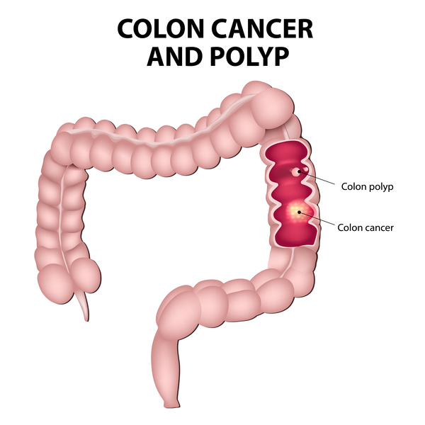 hereditary nonpolyposis colorectal cancer (hnpcc)
